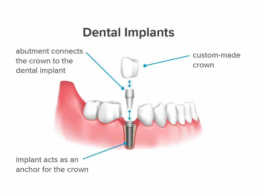 Implants