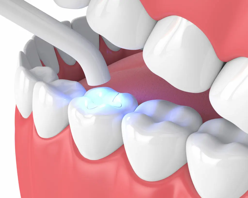 amalgam-vs-composite-1