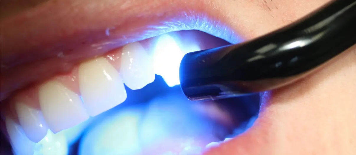 The Pros & Cons of Amalgam and Composite Fillings