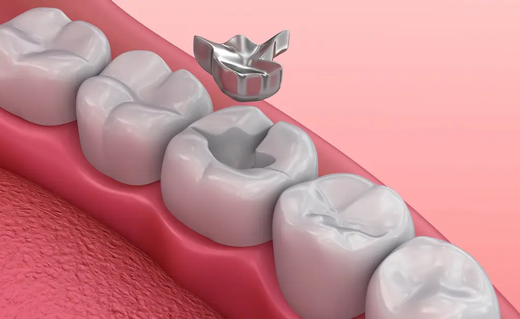 amalgam-vs-composite